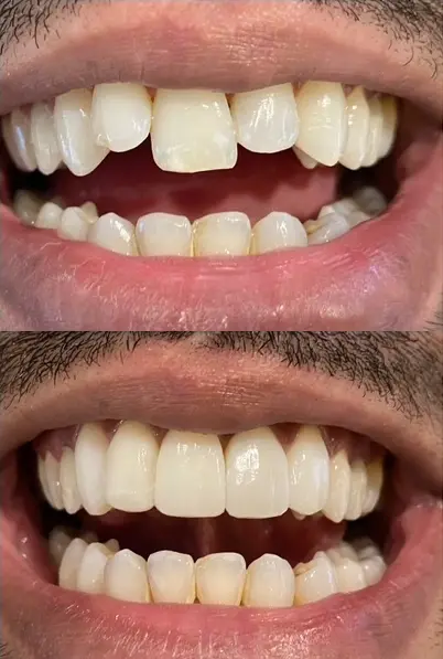 Facings bij Tandarts Amsterdam: voor en na foto