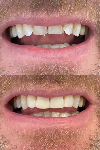 Facings bij Tandarts Amsterdam: voor en na foto