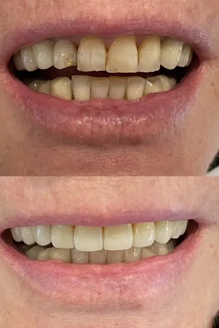 Facings bij Tandarts Amsterdam: voor en na foto