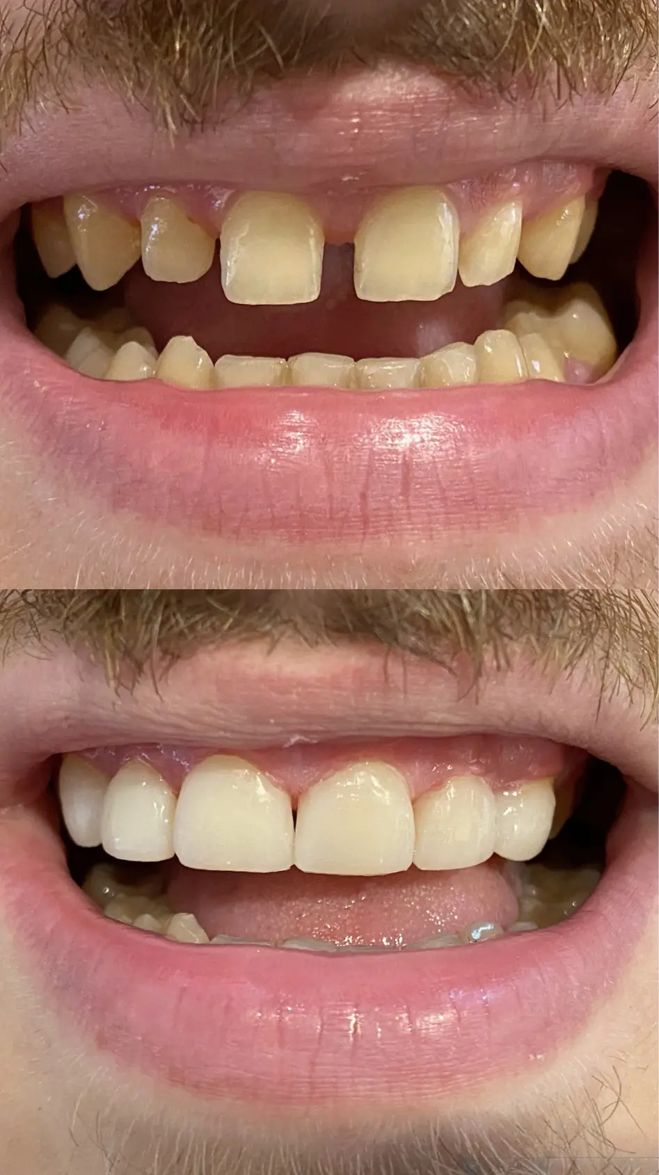 Facings bij Tandarts Amsterdam: voor en na foto