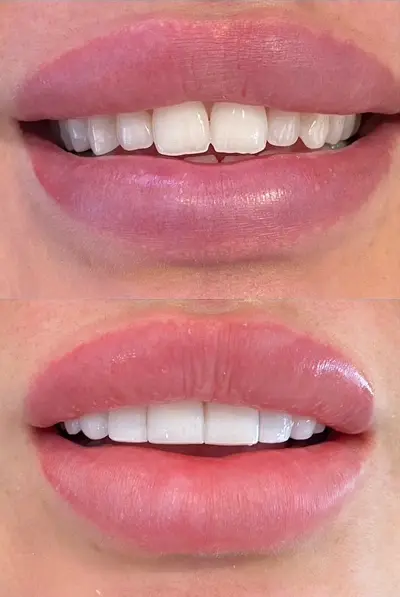 Facings bij Tandarts Amsterdam: voor en na foto