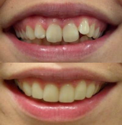 Facings bij Tandarts Amsterdam: voor en na foto