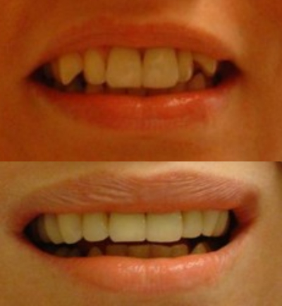 Facings bij Tandarts Amsterdam: voor en na foto