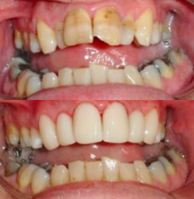 Facings bij Tandarts Amsterdam: voor en na foto
